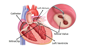percutaneous valve implantation including tavi in south delhi