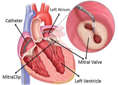 percutaneous valve implantation including tavi